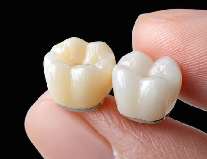 Dental Crowns in Restorative Dentistry Enhance Your Smile and Confidence