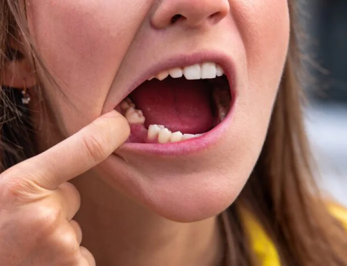 Effective Solutions for Missing Teeth Restoration