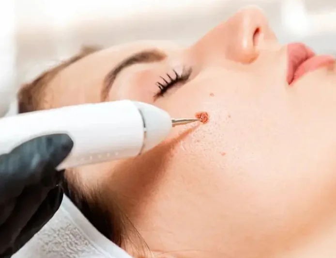 Laser vs Surgical Mole Removal in Riyadh