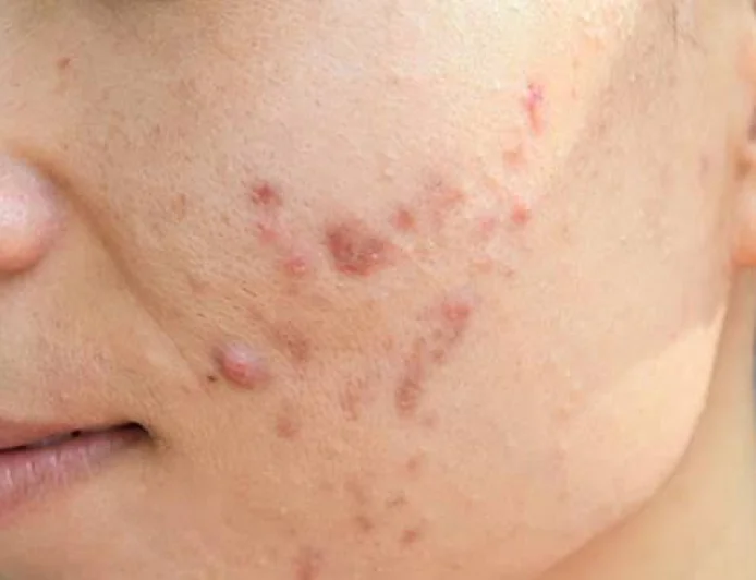 How Can Pimples Treatment Help Clear Acne More Effectively?