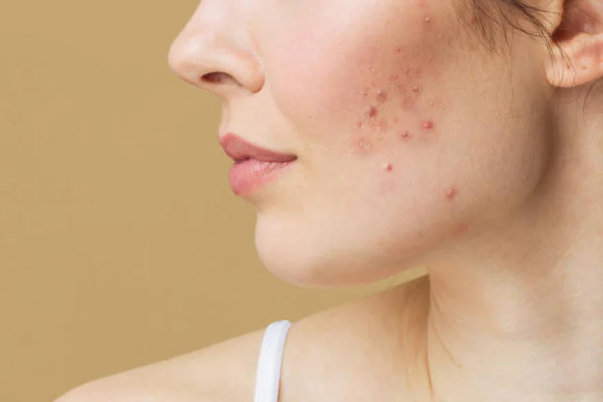 Which Acne Treatment works for oily skin