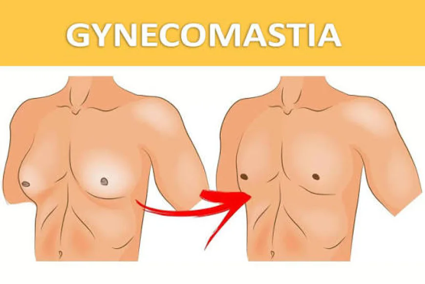 Understanding What Influences Gynecomastia Surgery Pricing