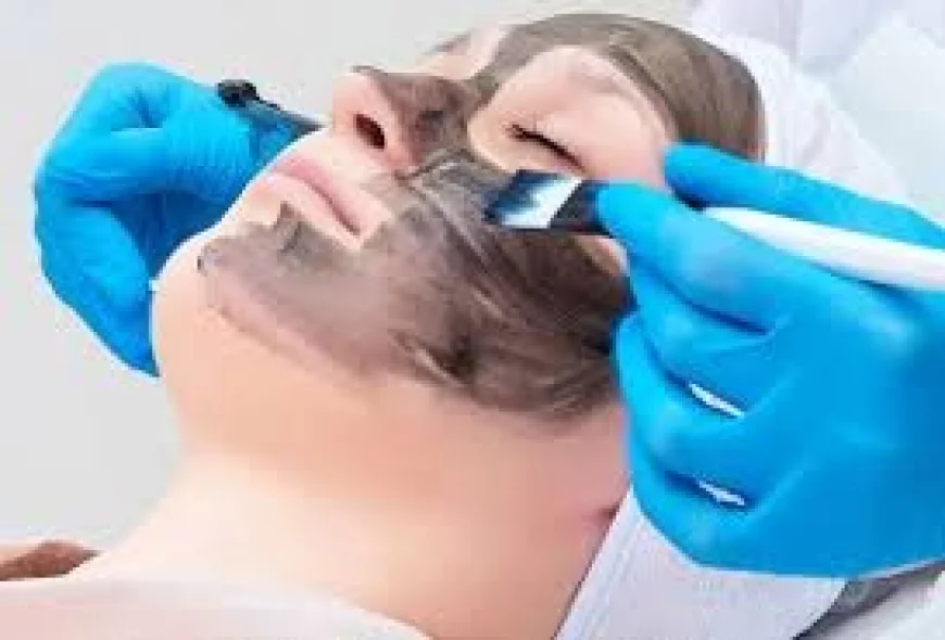 Carbon Peel for Acne, Open Pores and Dull Skin — What This Treatment Actually Does