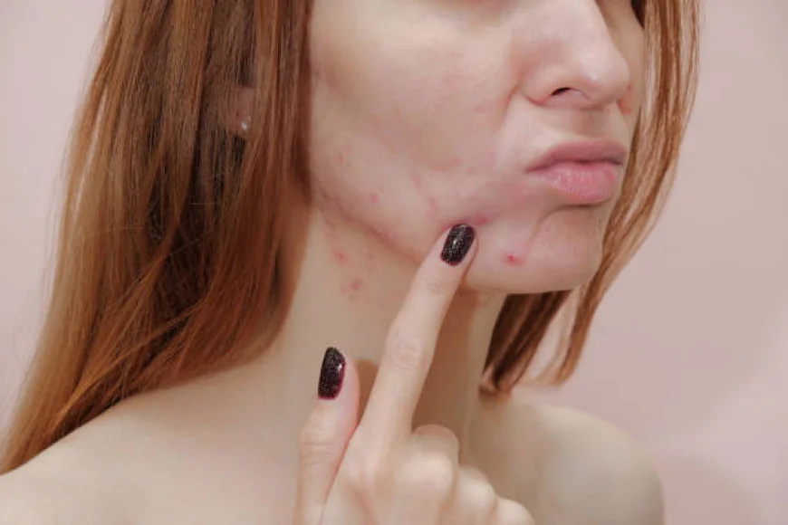 Does Laser Acne Scar Treatment Help Stubborn Scars?