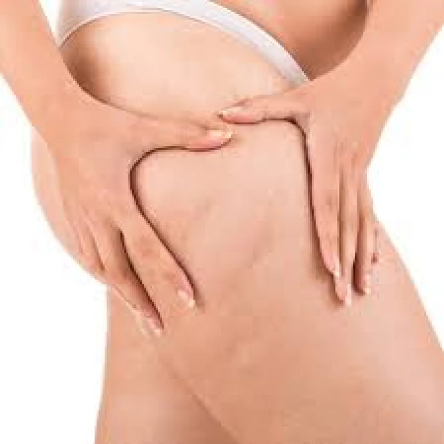 Cellulite Treatment in Dubai for Smoother and Firmer Looking Skin