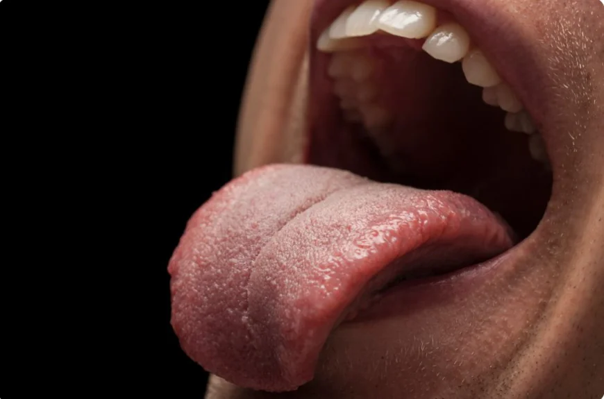 Tongue Ties, Feeding, and the Role of Orofacial Myofunctional Therapy
