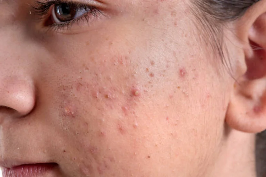 Which Acne Treatment suits oily skin best