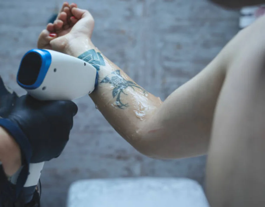 Does Laser Tattoo Removal leave scars