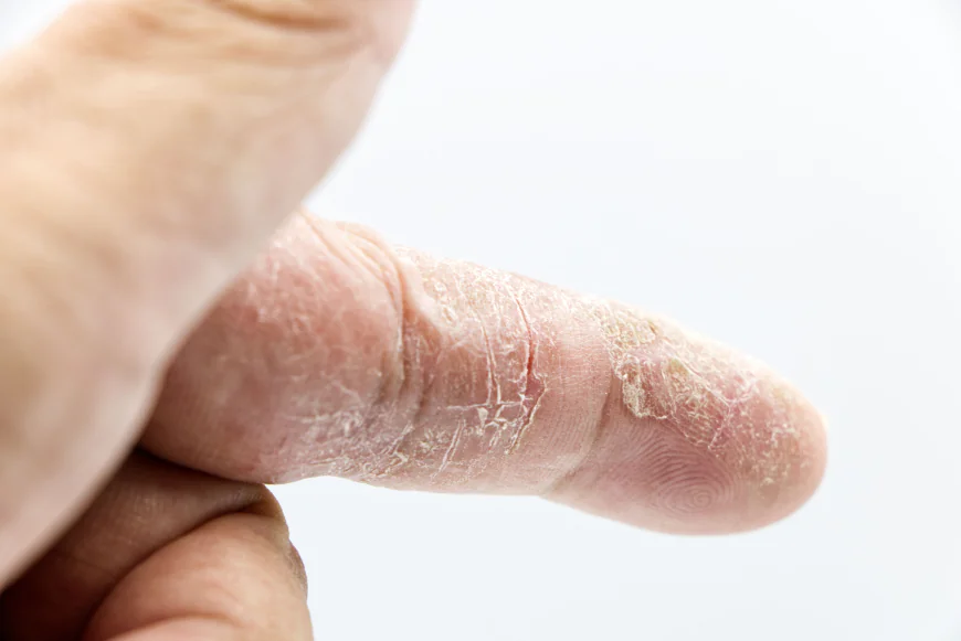 Psoriasis Treatment Market: Size, Trends, Growth, and Strategic Insights