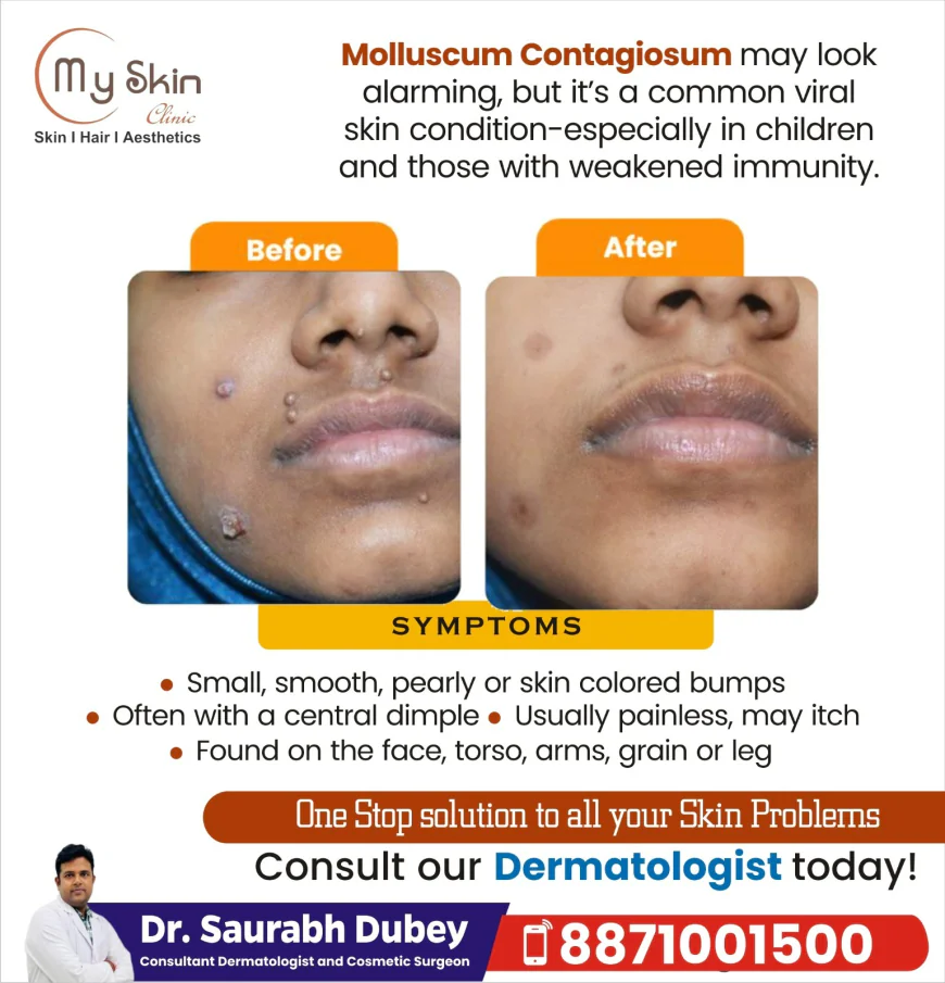 Molluscum Contagiosum Treatment in Indore