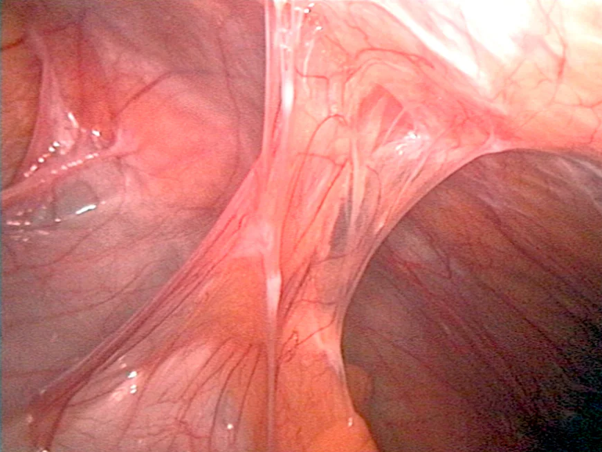 Abdominal Adhesions: Symptoms, Causes, and Treatment Options