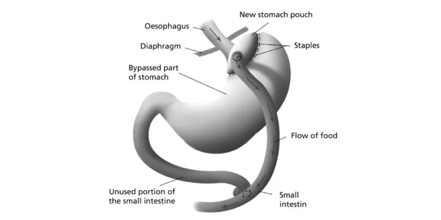 Foods to Avoid After Gastric Bypass Surgery for Better Health