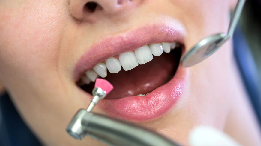 Teeth Cleaning in Dubai: Benefits You Should Know