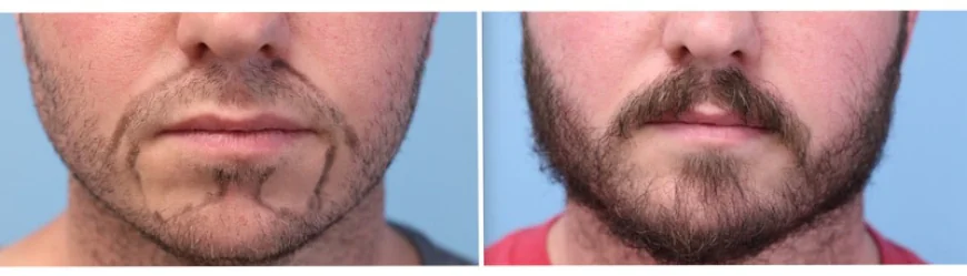 How does Facial Hair Restoration Work?