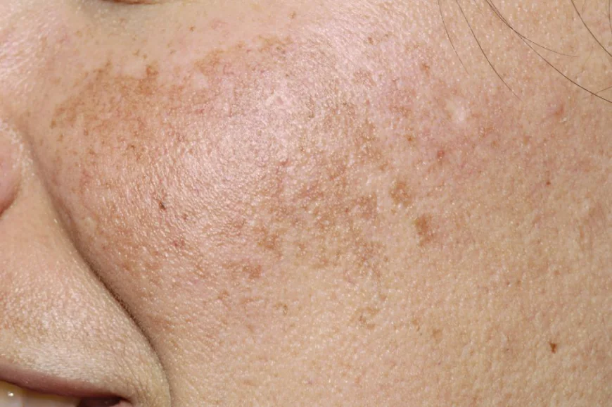 Is Pigmentation Treatment Safe for Sensitive Facial Skin