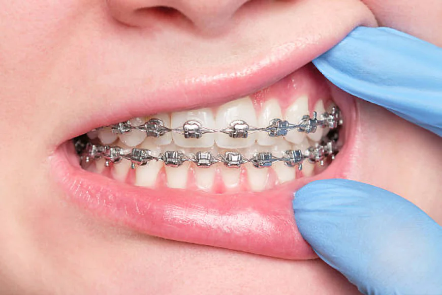 Dental Braces in Dubai for a Straighter Smile