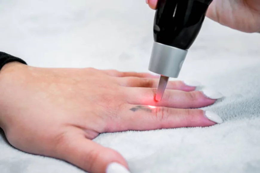 Can Laser Tattoo Removal Improve Tattoo Appearance?