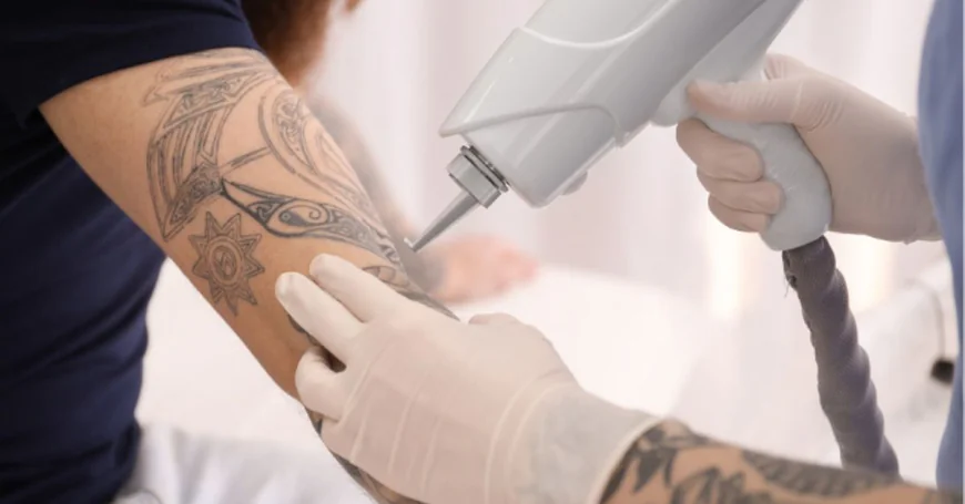 How Can Tattoo Removal Improve the Look of Faded Tattoos?