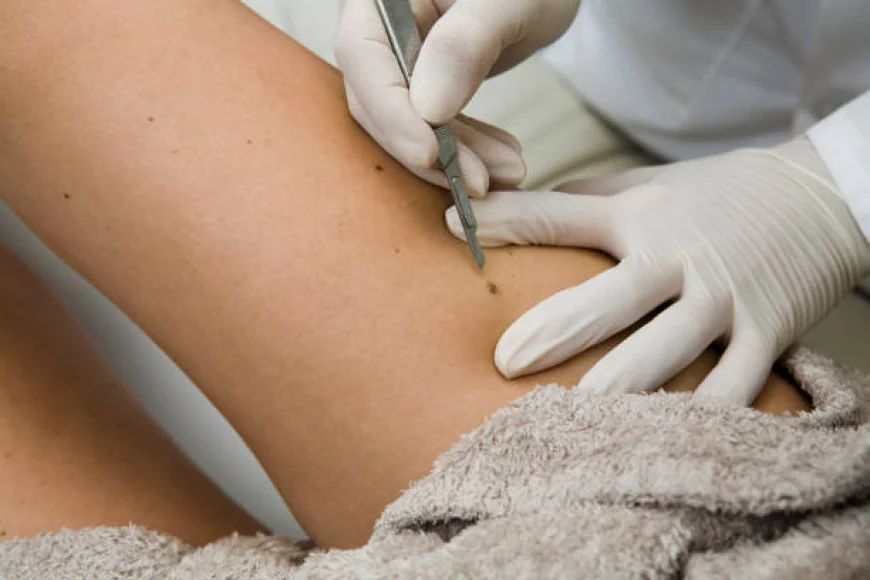 Can Skin Tag Removal Treatment Remove Multiple Skin Tags