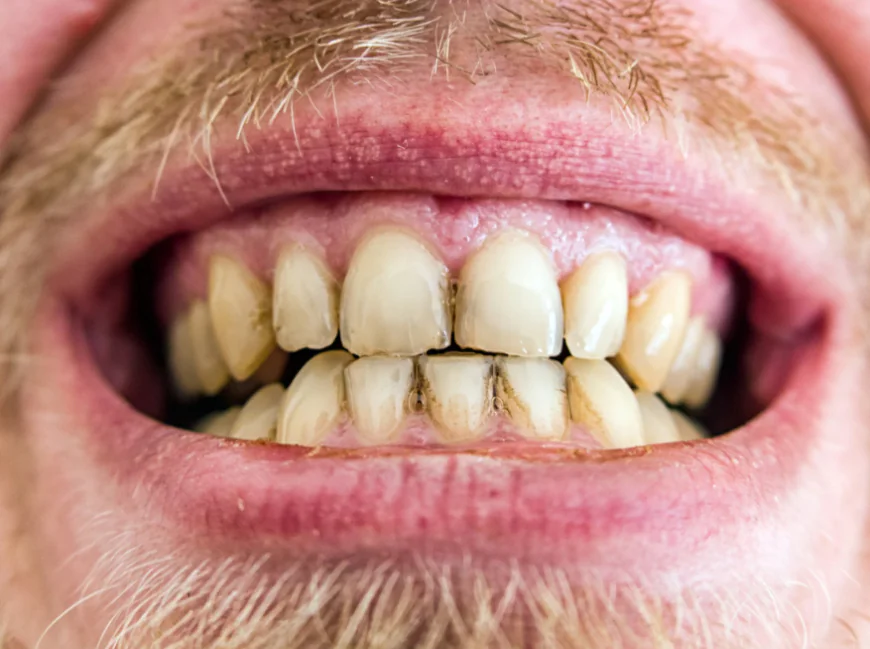 Yellow vs Grey Teeth: Can Whitening Treat Both?