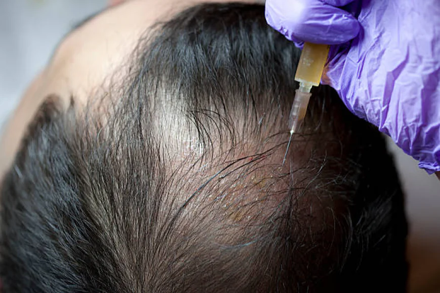 Does Concentrated Growth Factor Treatment Help Hair Loss