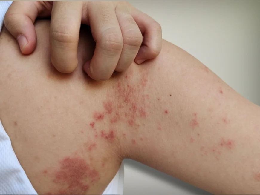 Can Poor Hygiene Cause Skin Diseases?
