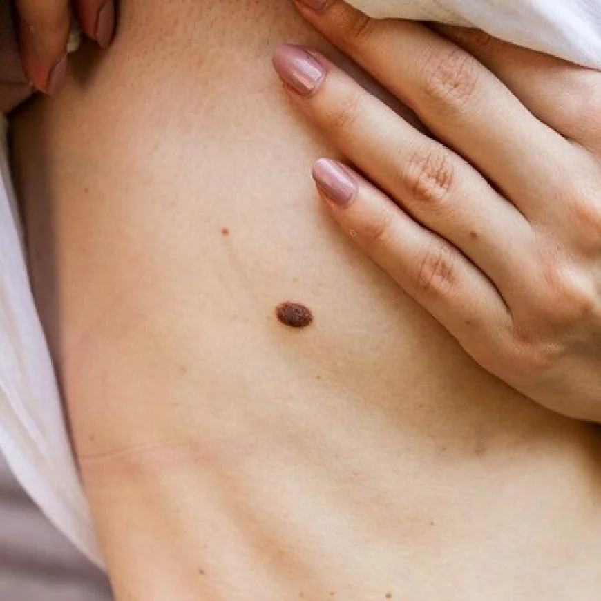 Can Skin Tag Removal Be Done Without Surgery Safely?