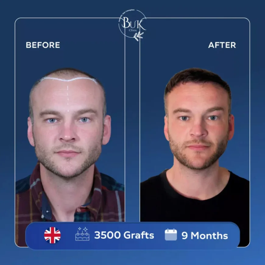 Hair Transplant Operation Turkey: A Complete Guide for International Patients