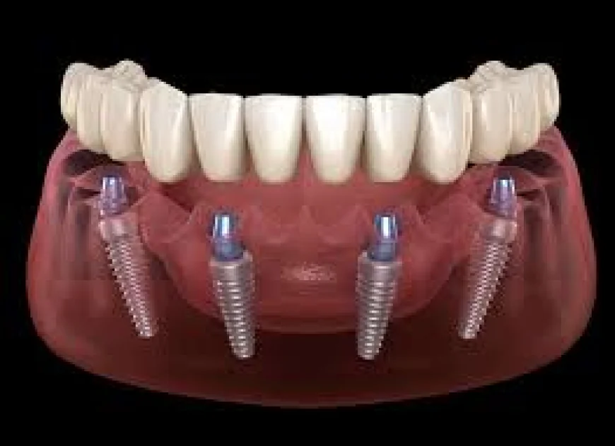 All-on-4 Dental Treatment: Understanding Your Options for Tooth Replacement