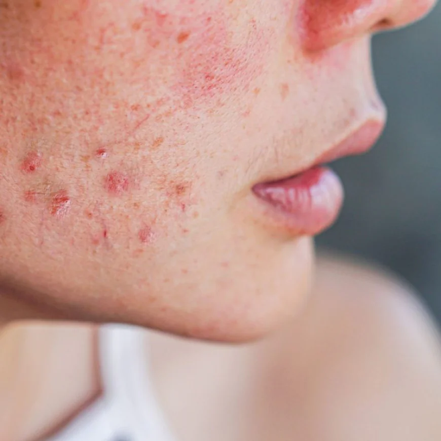 How Can Acne Treatment Improve Skin Texture?