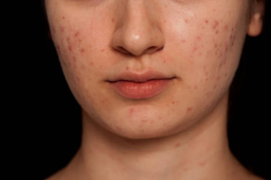 Can Laser Acne Scar Treatment Refine Rough Skin?