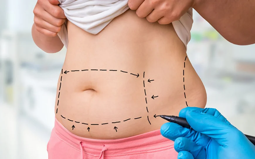 Does Liposuction Reduce Fat in Multiple Areas?