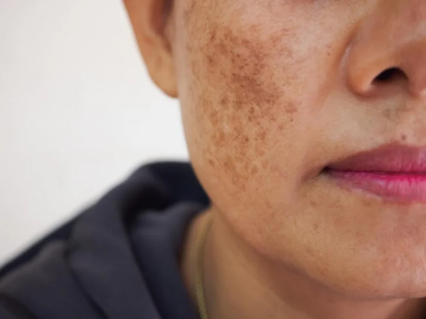 What Skincare Helps Reduce Dermal Pigmentation?