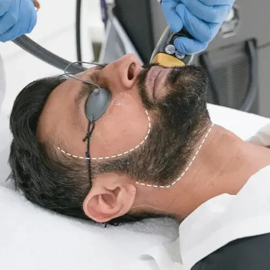 Does Beard Laser Hair Removal Work on Thick Beards?