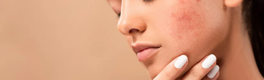 Acne Scar Treatment for Clearer-Looking Skin