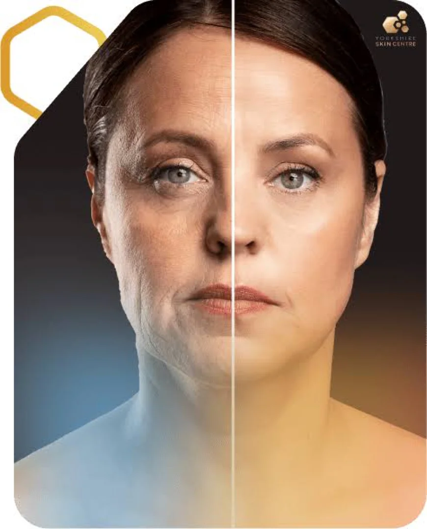 How Can Fotona SmoothEye Improve the Appearance of the Delicate Eye Area?