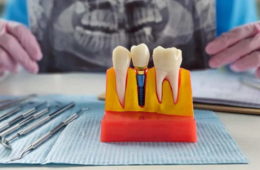 Implant Dentist: What to Expect During Your Implant Procedure Skills