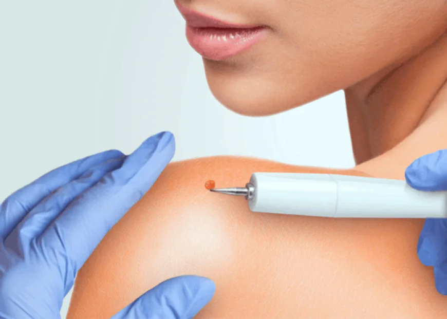 Is Skin Tag Removal Ideal for Old Skin Concerns and Clarity?