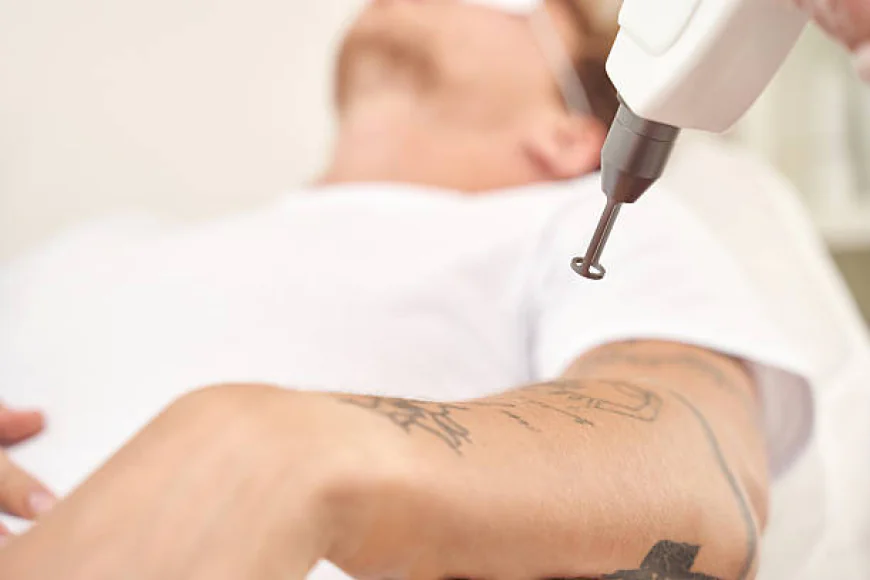 Can Laser Tattoo Removal Help Remove Tattoo Regret?