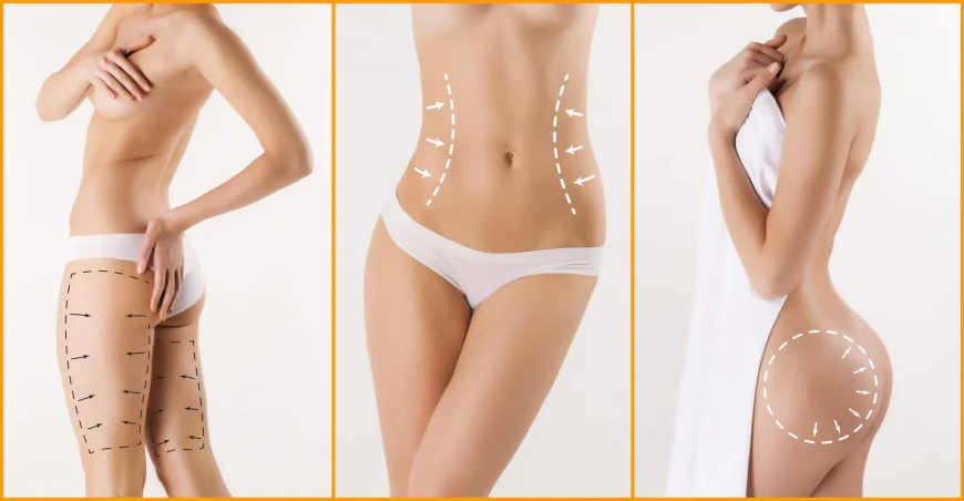 Understanding Stubborn Fat Pockets Before Choosing Liposuction in Islamabad