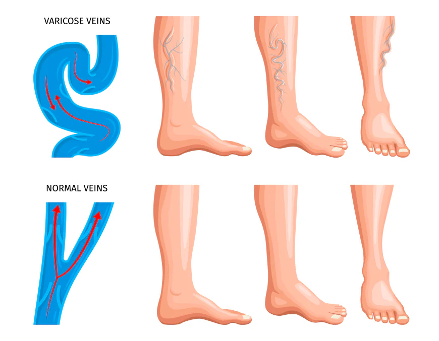 What Causes Varicose Veins? Risk Factors, Symptoms & Treatment