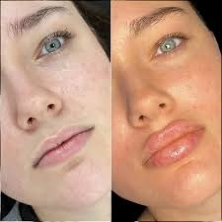 Best Doctors in dubai for Premium Cosmetic Dermal Fillers