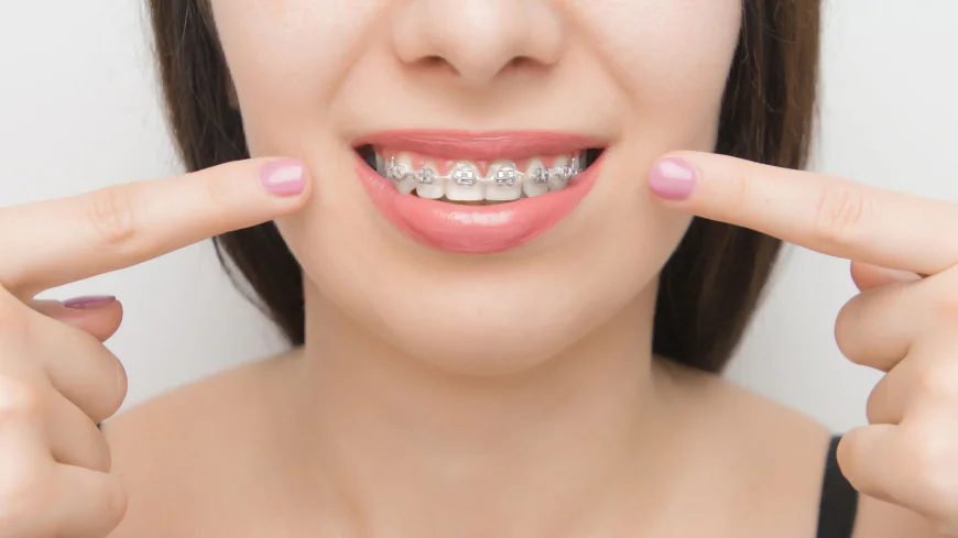 Dental Braces for Closing Gaps Between Teeth