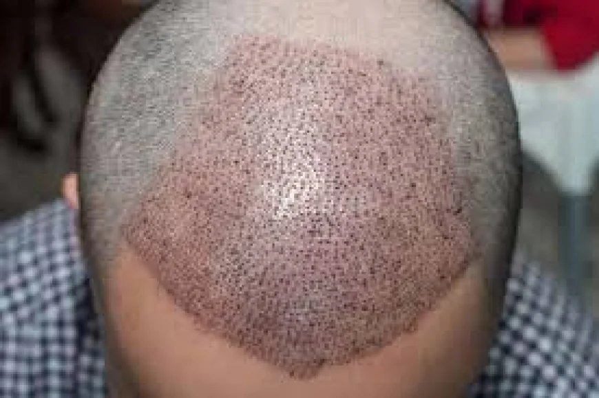 FUE Hair Transplant in Dubai | Modern Hair Restoration Guide
