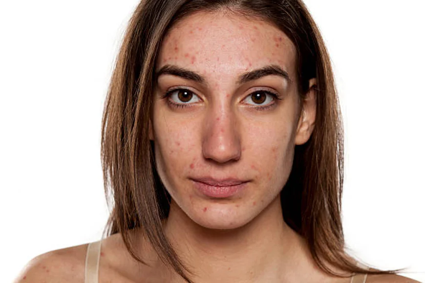 Can Acne Treatment Help Clear Congested Acne-Prone Skin?
