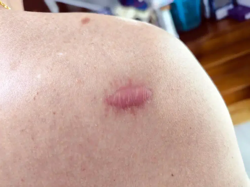 What Are the Benefits of Keloid Treatment?