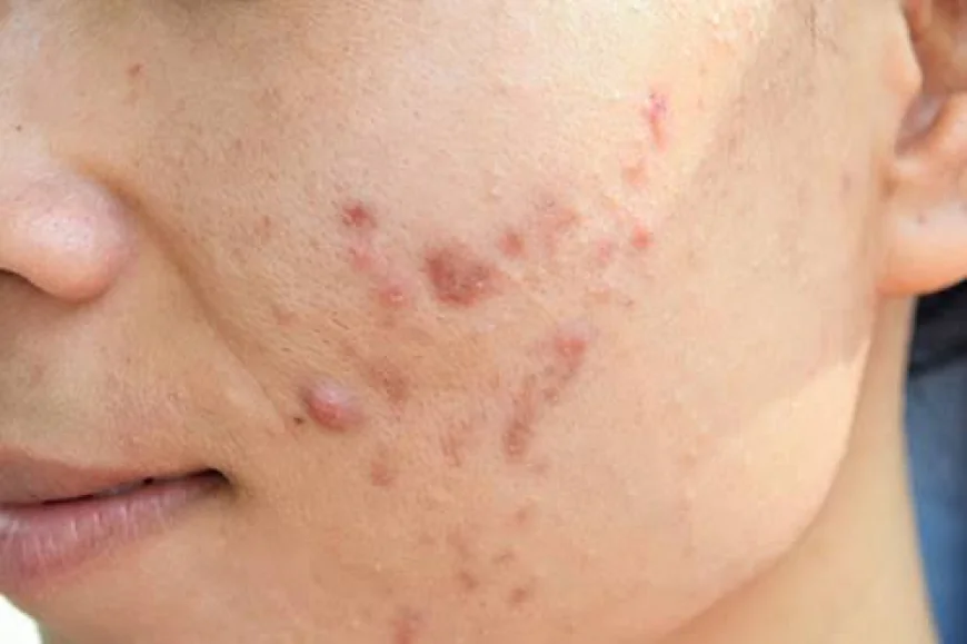 Is Acne Treatment Safe for All Skin Types?