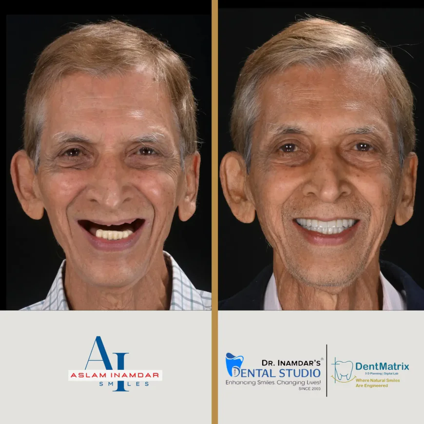 Full Mouth Rehabilitation: More Than Just Teeth Replacement