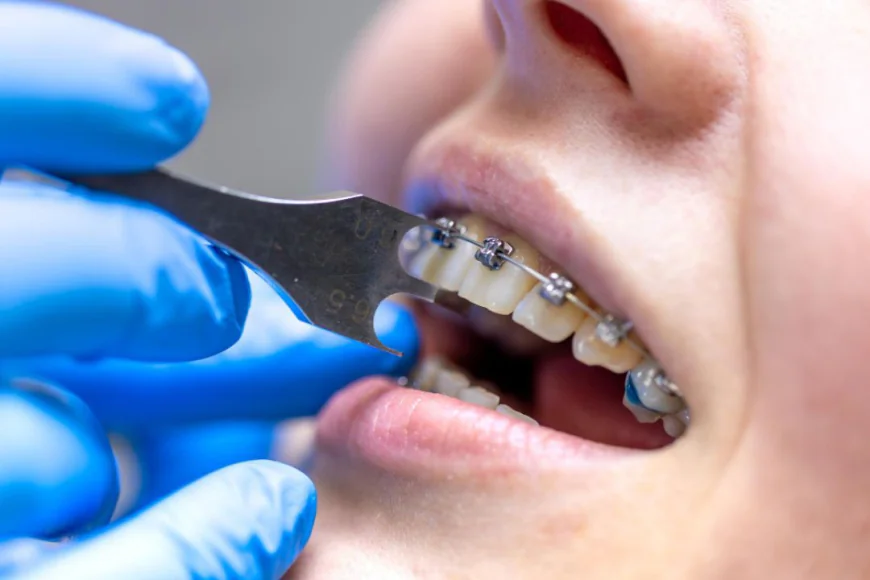 Affordable Braces and Same-Day Dental Implants in Houston