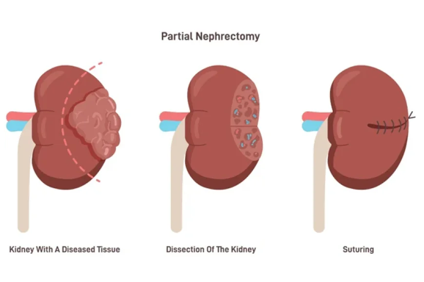 Partial Nephrectomy in Gurgaon: Preserving Kidney Function with Modern Surgical Care
